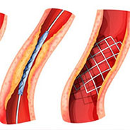 peripheral-vascular-angioplasty