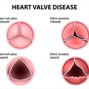 valvular-heart-disease